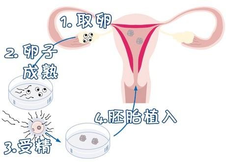 三代试管代怀生子